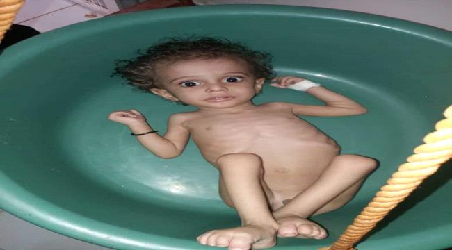 4 آلاف يعانون سوء التغذية .. أهالي أزارق #الضـالع يستغيثون لإنقاذ أطفالهم من الموت جوعاً - صور