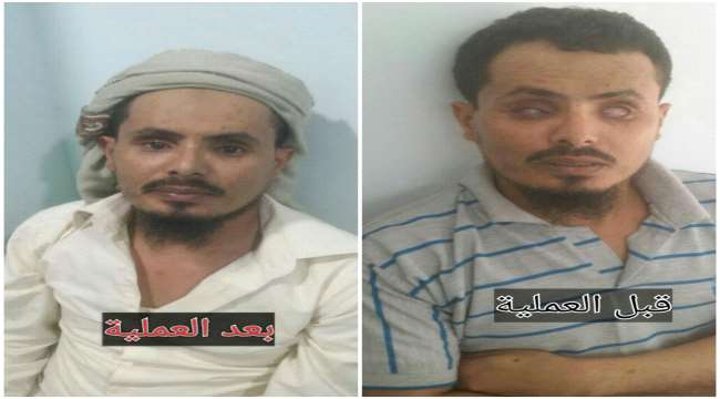 قصة جريح أفقدته رصاصة قناص حوثي البصر بشكل نهائي .. وعينين صناعيتين بديلتين ( صورة )