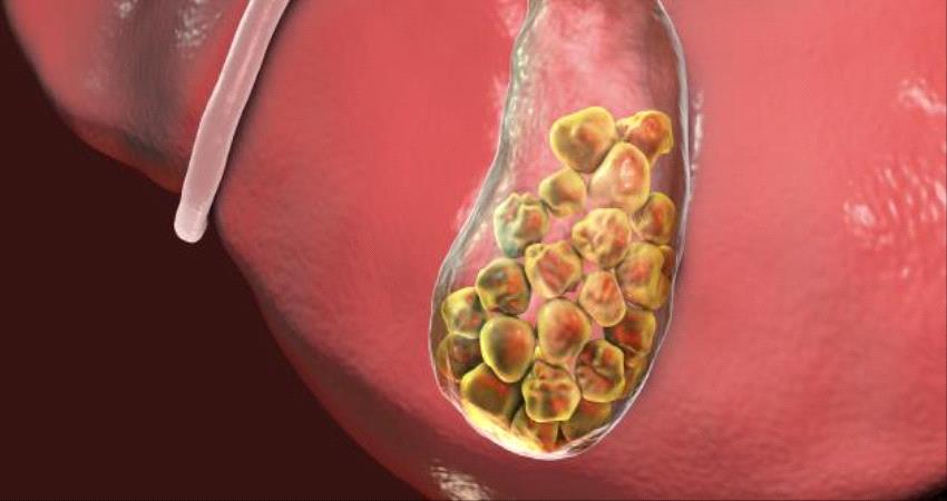 10 طرق طبيعية لعلاج وتفتيت حصوات الكلى