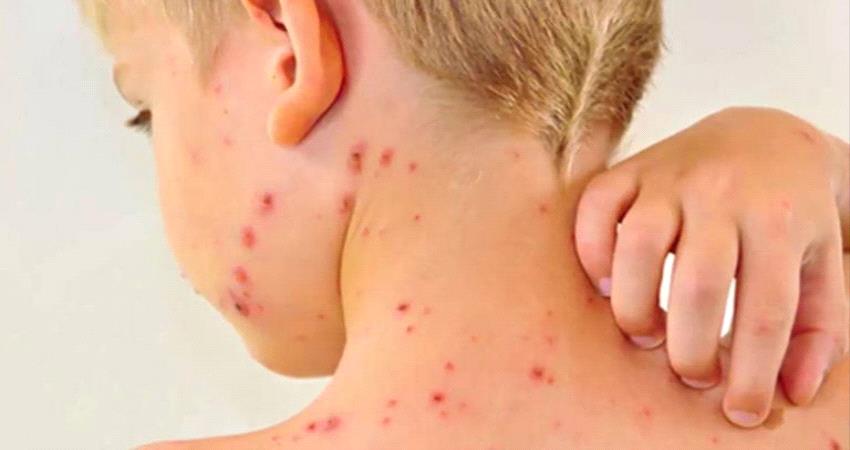تعرف على أعراض الحصبة الألمانية وطرق انتقالها وعلاجها