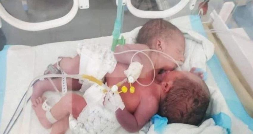  "توأم صنعاء السيامي" يكشف متاجرة الحوثي بالإطفال