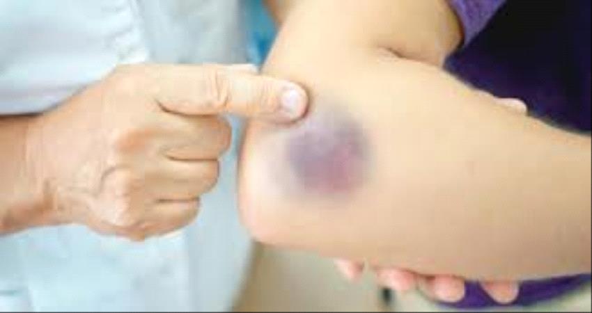 خطير..أسباب الظهور المفاجئ للبقع والكدمات على مناطق في الجسم