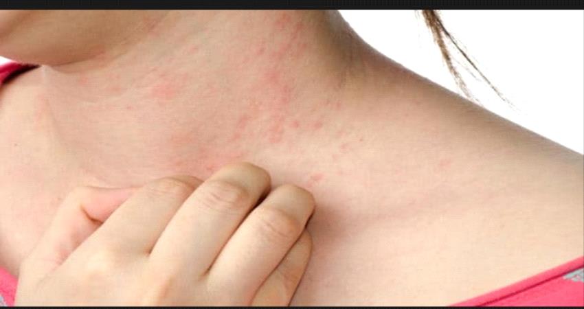 إكتشاف أعراض جديدة لفيروس كورونا!