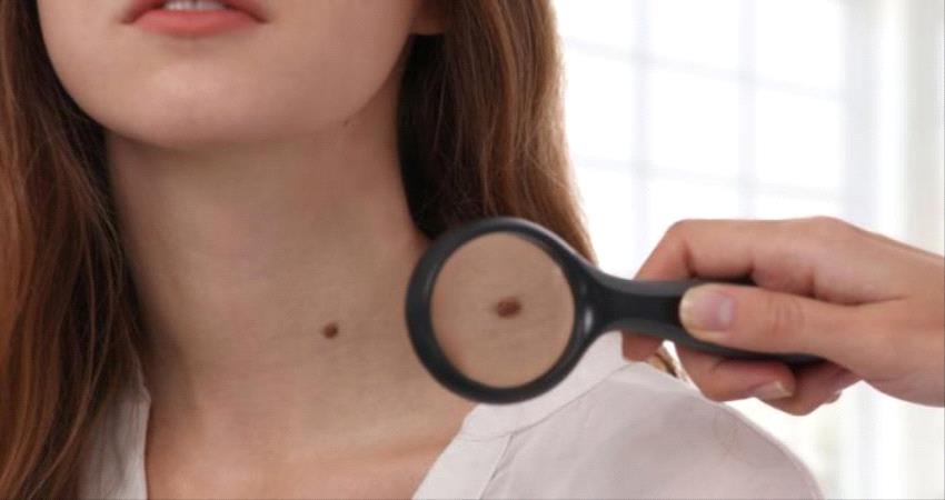 تعرف على 5 علامات تمثل الشامة خطرا على الجلد