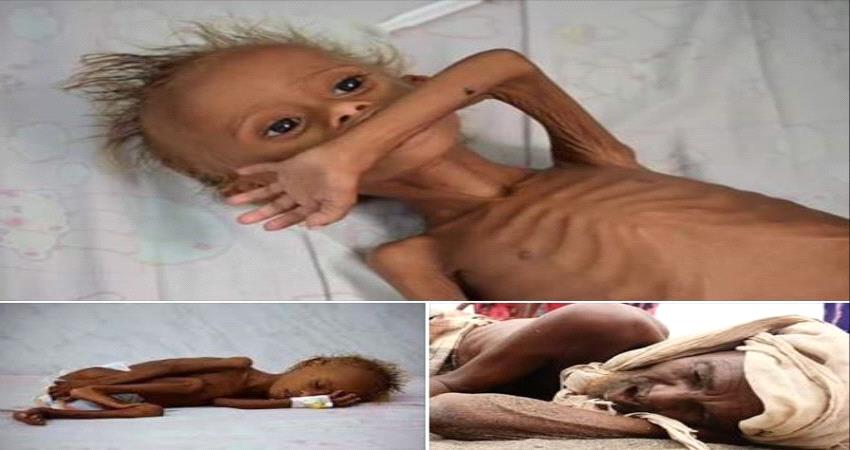 تحذيرات اممية من تعرض 3 دول للمجاعة من بينها اليمن