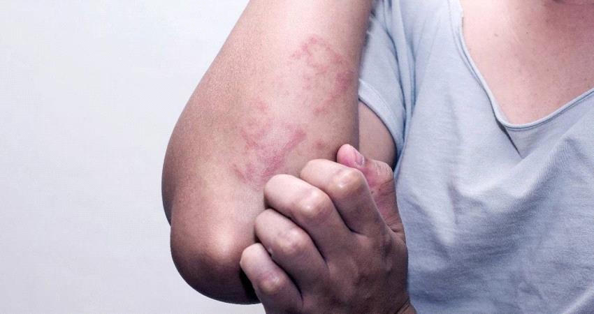 تعرف على 5 علاجات منزلية للتغلب على فطريات و التهابات الجلد