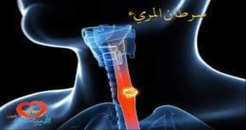 "ابريل" شهر التوعية بسرطان المرىء ..فما هذا الورم وأسبابه وعلاجه