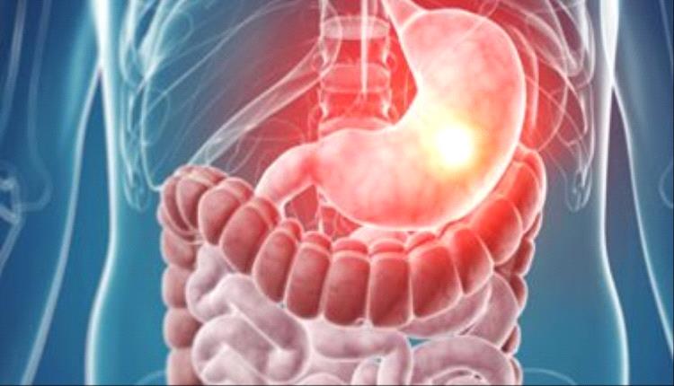 8 علاجات طبيعية لقرحة المعدة.. أبرزها الصبار والثوم