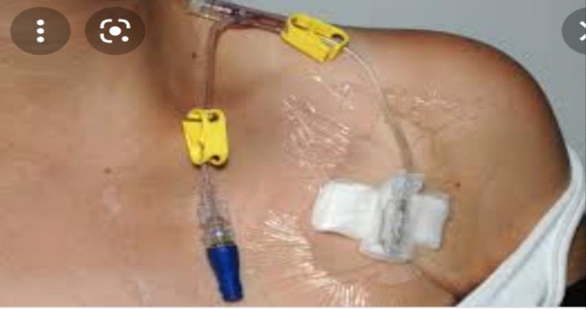 ماذا تعرف عن البورت كاث أو الكيمو بورت؟