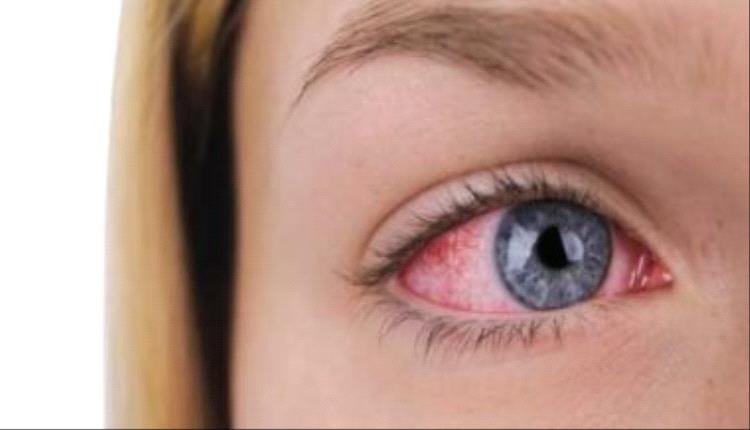8 نصائح لمنع التهابات العيون والحساسية الموسمية