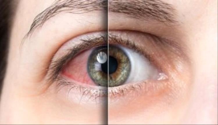 أسباب جفاف العين وطرق بسيطة لعلاجه