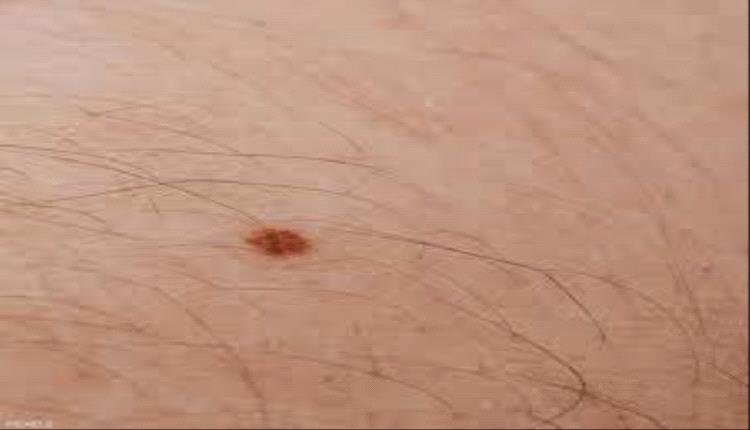 سرطان الجلد.. "هذه العلامة" دليلك للكشف المبكر