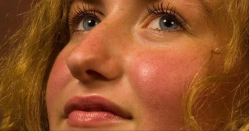 أسباب احمرار الوجه عديدة.. منها التهاب الجلد الدهنى