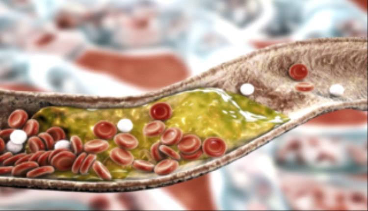 انسداد الشرايين سببها الكوليسترول