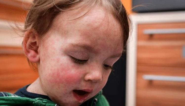 أعراض الحصبة الألمانية لدى الأطفال في الشتاء