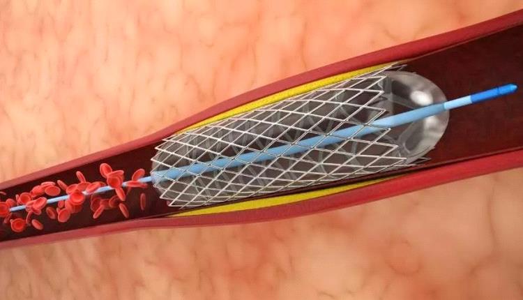 علاج السكته الدماغية وتقليل خطر الاصابة