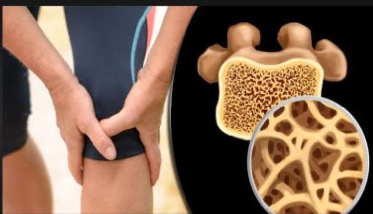 أطعمة تساعدك على التخلص من هشاشة العظام