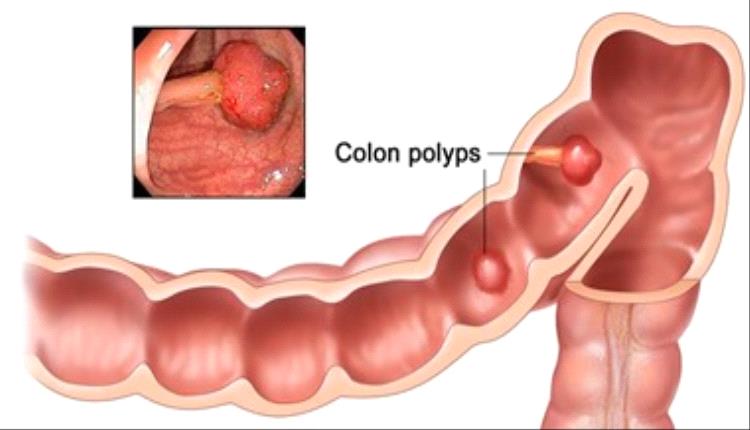 ما سرطان القولون تعرف على أبرز علاماته