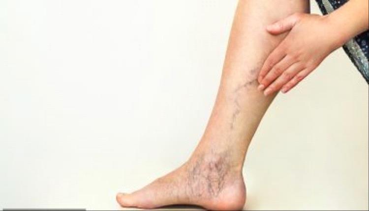 لمرضى دوالي الساقين.. تعرف على طرق العلاجات المختلفة
