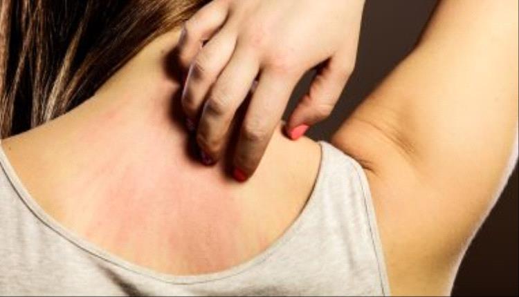 5 وصفات طبيعية لعلاج الطفح الجلدي