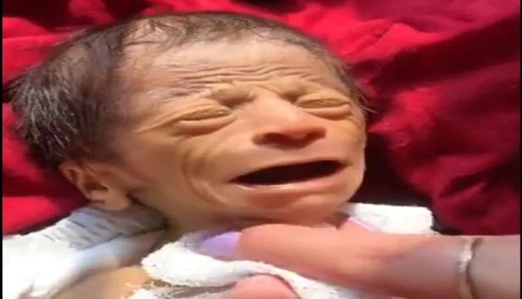 صور - ولادة طفل بوجه رجل عجوز