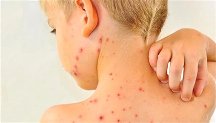 بعد تفشيه في الهند.. تعرف على أعراض الإصابة بالحصبة الألمانية
