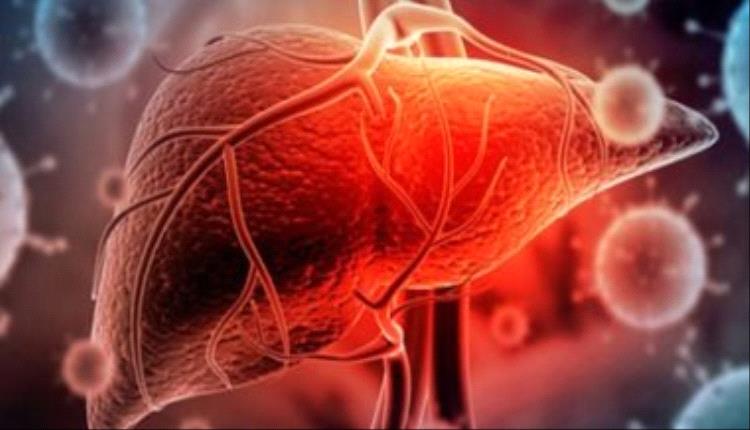 تورم البطن علامة تشير للإصابة بسرطان الكبد