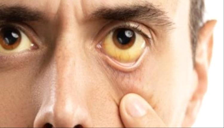 نقطة بيضاء وسط العين عند استخدام الفلاش يشير إلى الإصابة بسرطان الشبكية