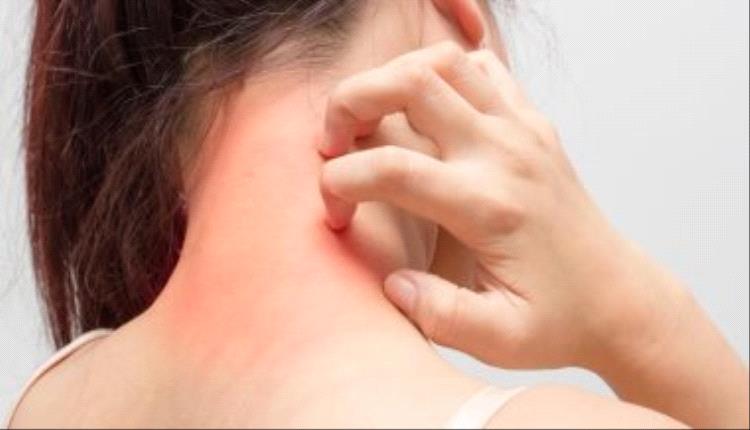 4 أسباب وراء الإصابة بمرض الصدفية.. اعرفها