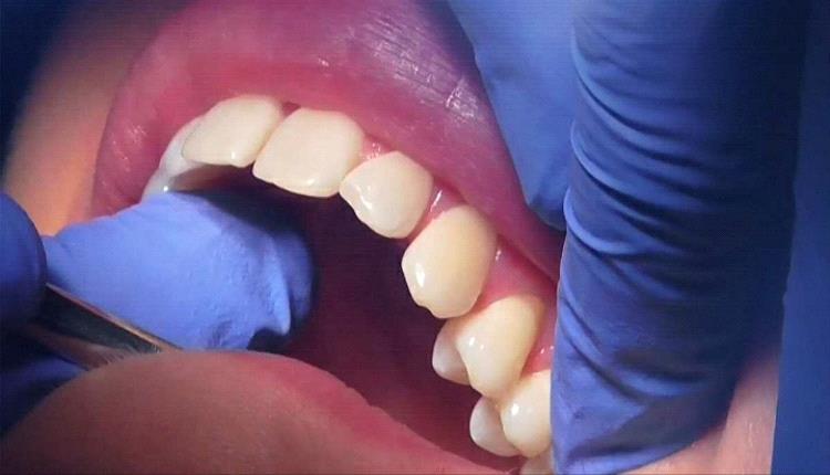 بشرى جديدة.. تطوير دواء لانبات أسنان جديدة للبشر