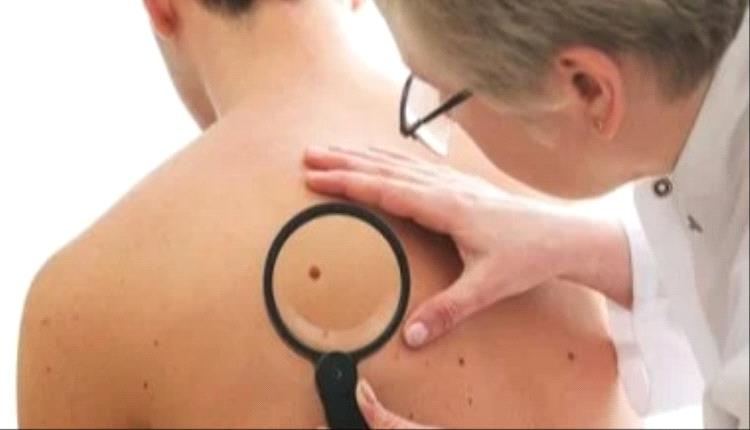 FDA توافق على علاج بالخلايا الجذعية للمصابين بسرطان الجلد 