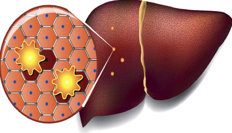 بهذه الطريقة ستقود الكبد الى الإصابة بالسرطان 