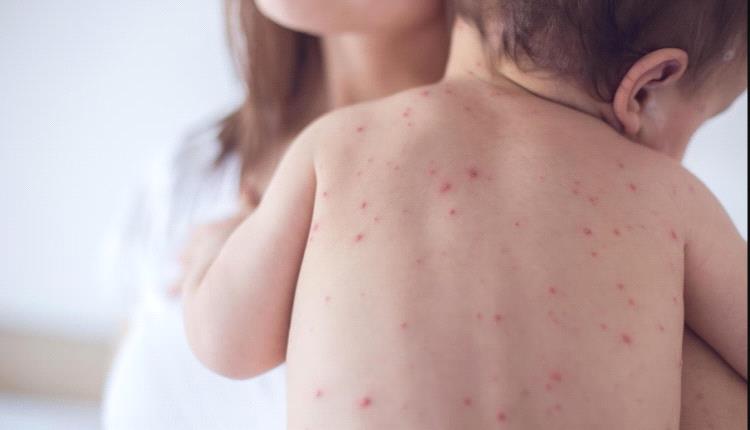 الصحة العالمية: تراجع الوفيات بسبب الحصبة في العالم بنسبة 88% منذ عام 2000

