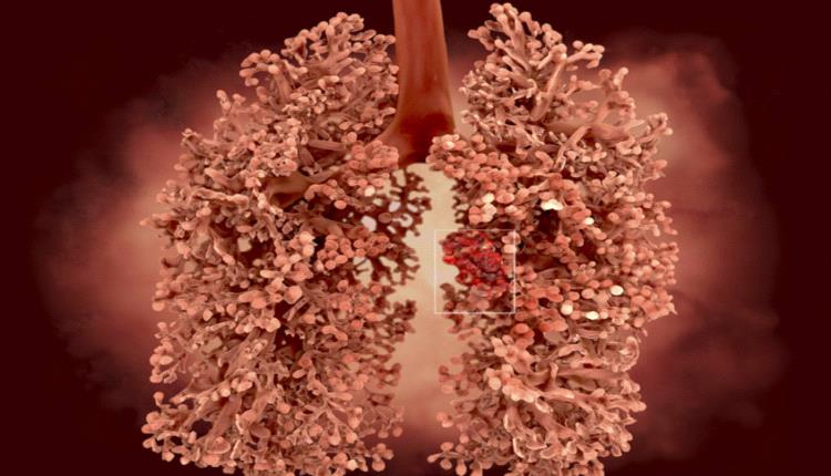 خطورة التعرض للإصابة بسرطان الرئة 