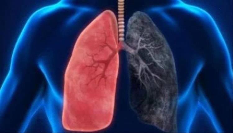 شهر التوعية بسرطان الرئة.. خطوات بسيطة تحافظ على صحة رئتيك