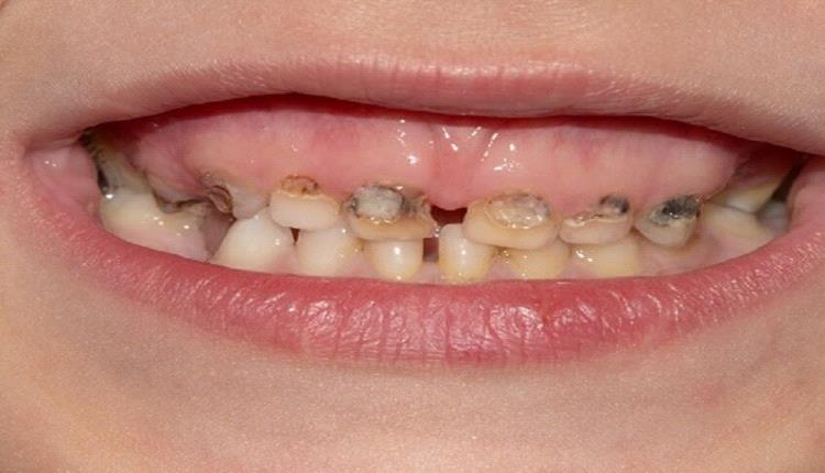 تسوس أسنان الأطفال...سبب لا تتوقعه !