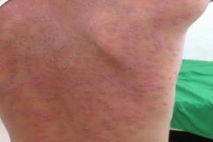 عشرات الإصابات بمرض "الجدري" تجتاح منطقة بلاد الأحمدي بالأزارق