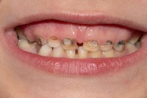 تسوس أسنان الأطفال...سبب لا تتوقعه !