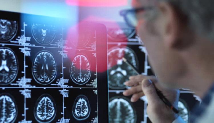 اكتشاف علمي..."الفياغرا" لعلاج الزهايمر 