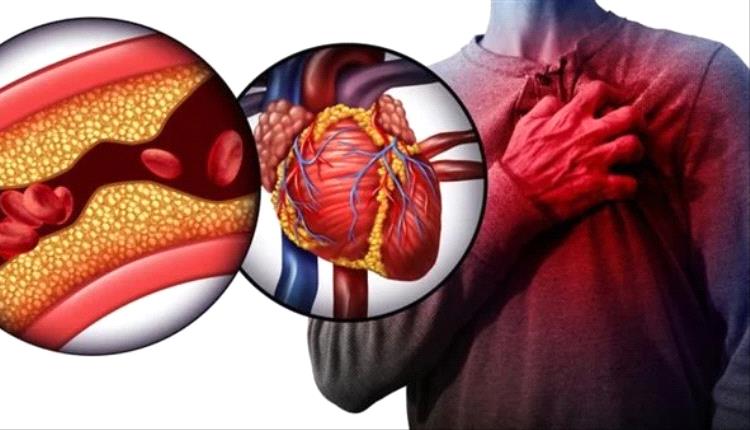 أسباب ارتفاع الكوليسترول الضار وطرق الوقاية والعلاج